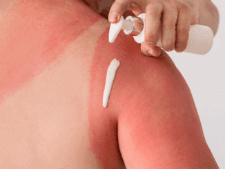 Woman putting lotion on her sunburned shoulder