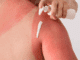 Woman putting lotion on her sunburned shoulder